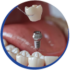 iconos dentales_protesis dental
